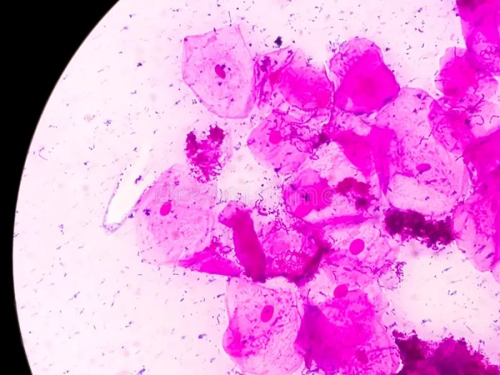 Bacterial Vaginosis In Men Bacterial vaginosis in men