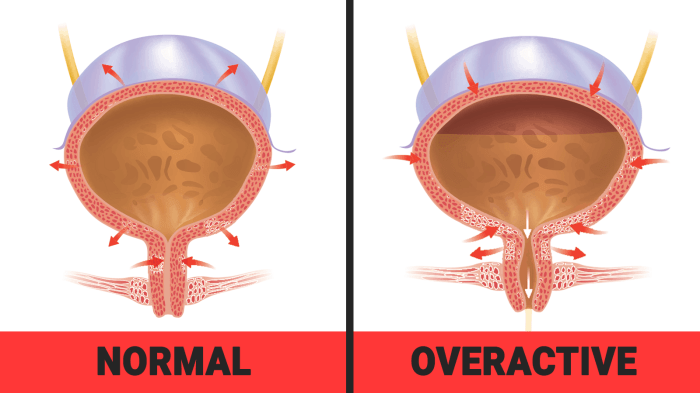What is Overactive Bladder? | St Pete Urology Overactive bladder in men