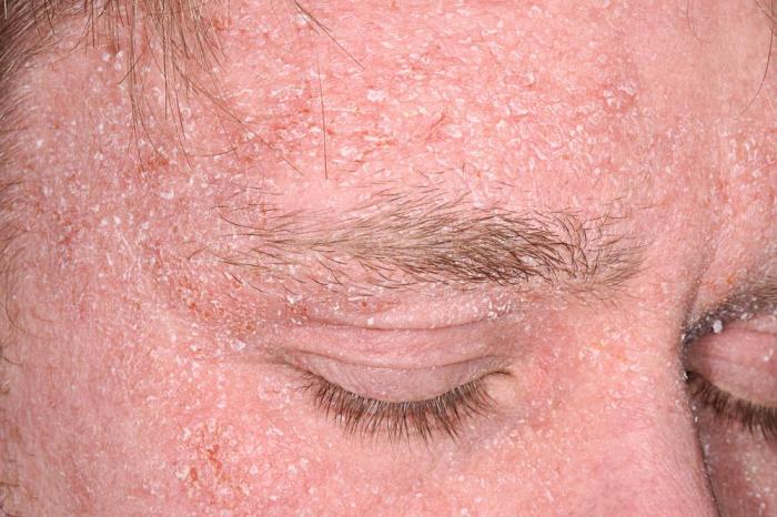 Seborrheic dermatitis hair loss