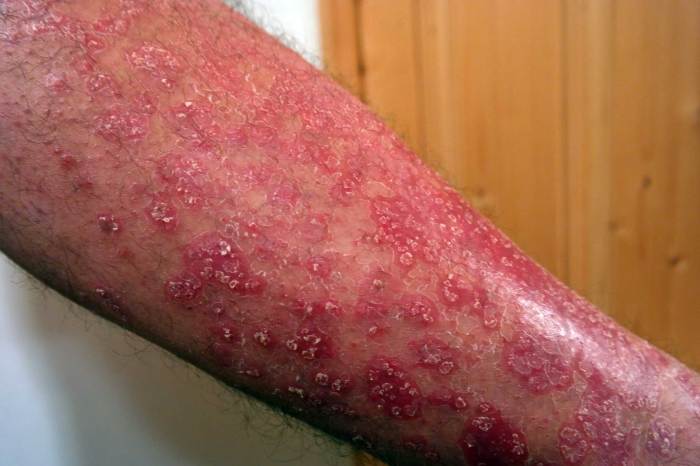 Psoriasis and covid vaccine