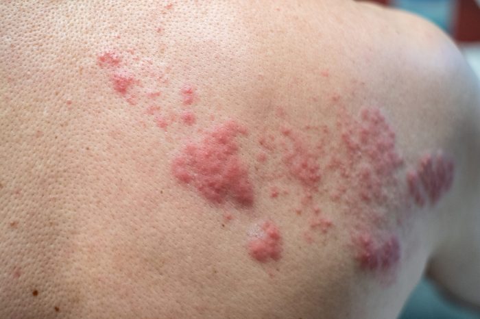 Top 65 Facts About Roof Shingles Shingles vaccine side effects