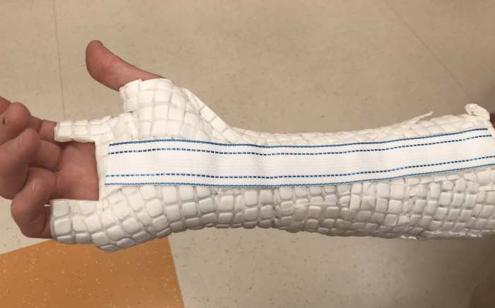 How to safely remove a cast with a cast saw