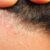 Seborrheic Dermatitis Hair Loss A Deep Dive