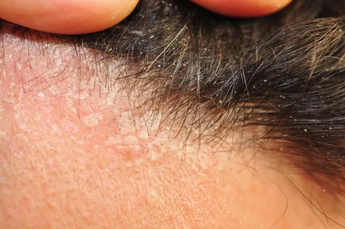 Seborrheic Dermatitis Hair Loss A Deep Dive