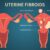 How Fibroid Pain Is Treated A Comprehensive Guide