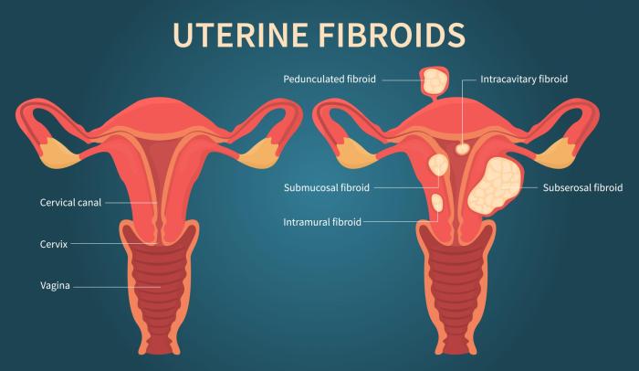 How Fibroid Pain Is Treated A Comprehensive Guide