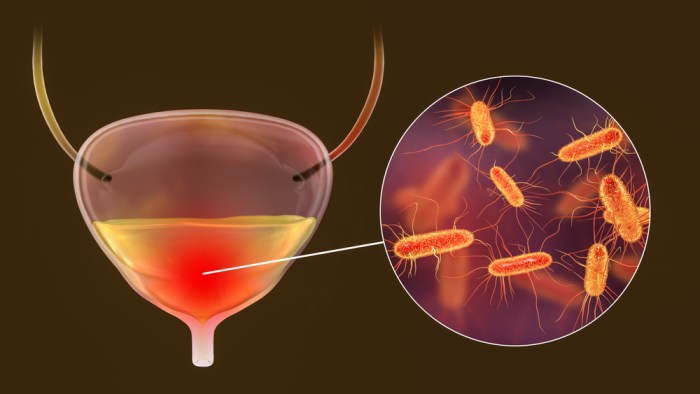 What causes bladder infections