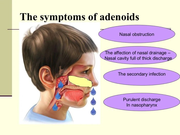 Chronic and Recurrent Tonsillitis A Deep Dive