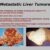 Lung Cancer Spread to the Liver A Deep Dive