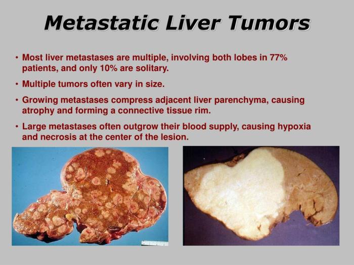 PPT - Liver Cancer PowerPoint Presentation, free download - ID:6399378 Lung cancer spread to the liver