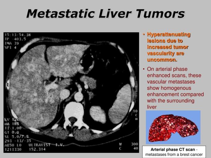 PPT - Liver Cancer PowerPoint Presentation, free download - ID:6399378 Lung cancer spread to the liver