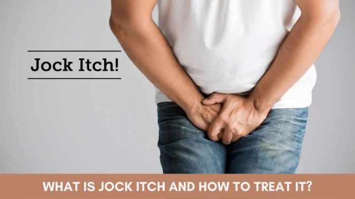 Jock Itch Black Skin Jock itch tinea cruris fungal infection