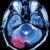 Migraine Trigger Food List Your Guide