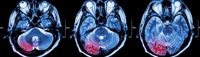 Migraine Trigger Food List Your Guide