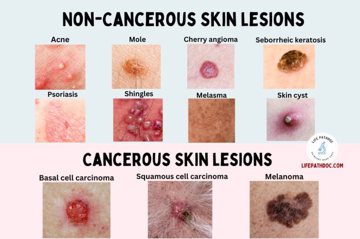Yeast infection on skin