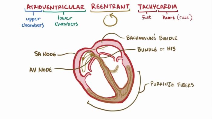 Atrioventricular reentrant tachycardia avrt