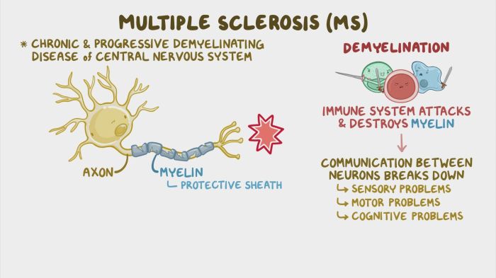 Dysesthesia and multiple sclerosis