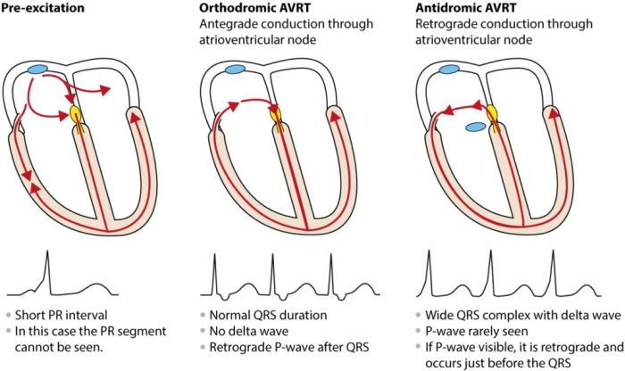 (PDF) Coexistence of Atrioventricular Nodal Reentrant Tachycardia with Other Forms of Arrhythmias Atrioventricular nodal reentrant tachycardia avnrt