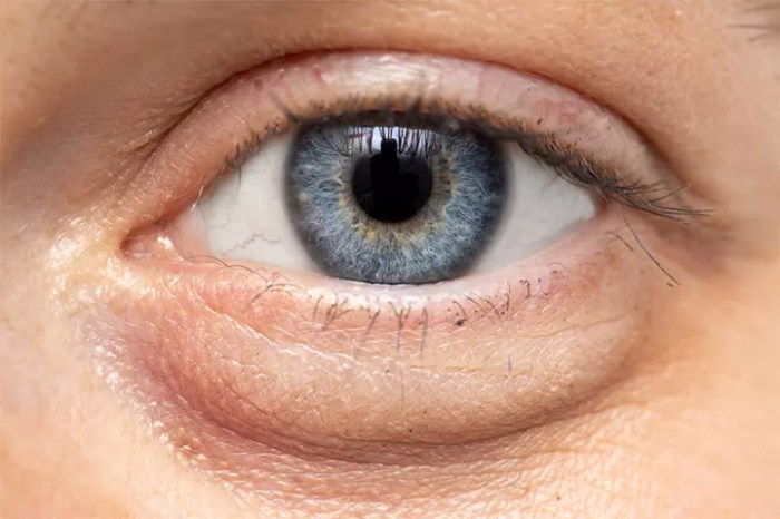 Eye Bags vs. Dark Circles: Causes, Treatments, and Prevention How to get rid of puffy eyes
