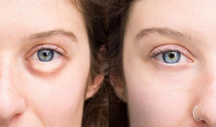 5 Reasons for Low Iron and How It Relates to Thyroid Disease - Suzy ... How to get rid of puffy eyes