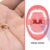 How to Get Rid of Tonsil Stones A Comprehensive Guide