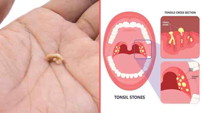 How to get rid of tonsil stones