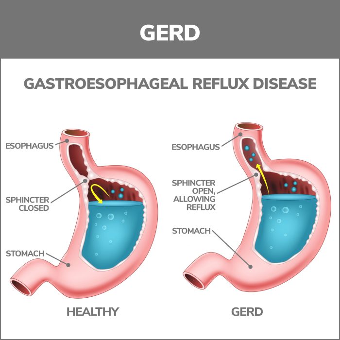 Esophageal Disorders | Gastroenterology of Greater Orlando Esophagus function and conditions