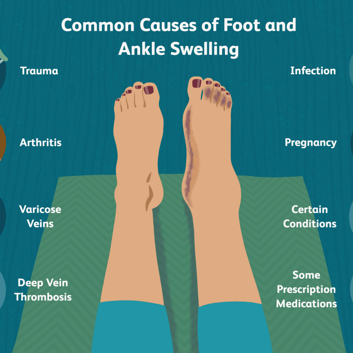 How To Keep Ankles From Swelling - Aimsnow7 Causes of ankle swelling