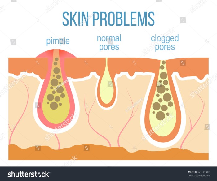 Difference between acne pimple and ingrown hair