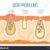 Difference Between Acne, Pimples, and Ingrown Hairs