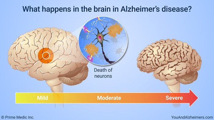 What causes death in people with alzheimers disease
