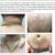 Hidradenitis Suppurativa on Face A Deep Dive
