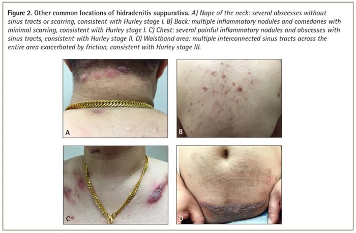 Hidradenitis Suppurativa on Face A Deep Dive