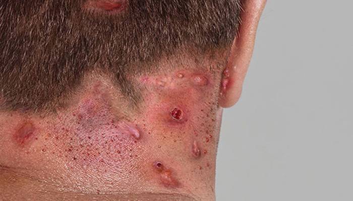 Hidradenitis Suppurativa: What Is It, Causes, Presentation, and More ... Hidradenitis suppurativa on face