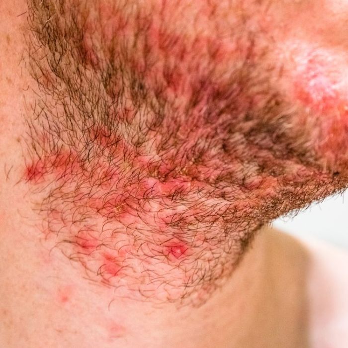 Hidradenitis suppurative and covid 19