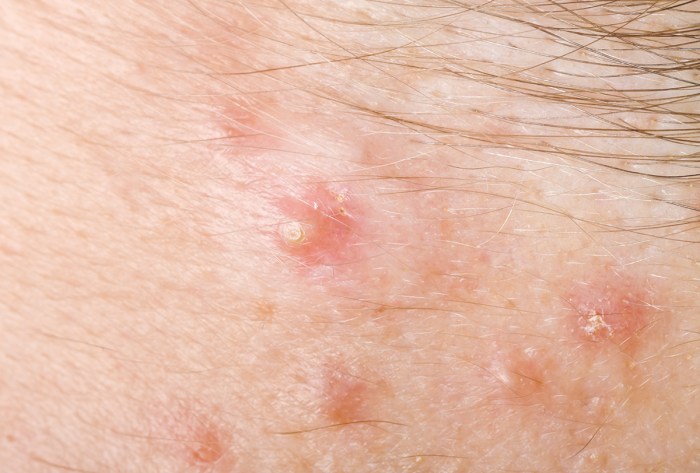 Hidradenitis suppurative and covid 19