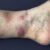 Panniculitis Causes Symptoms Treatments and More