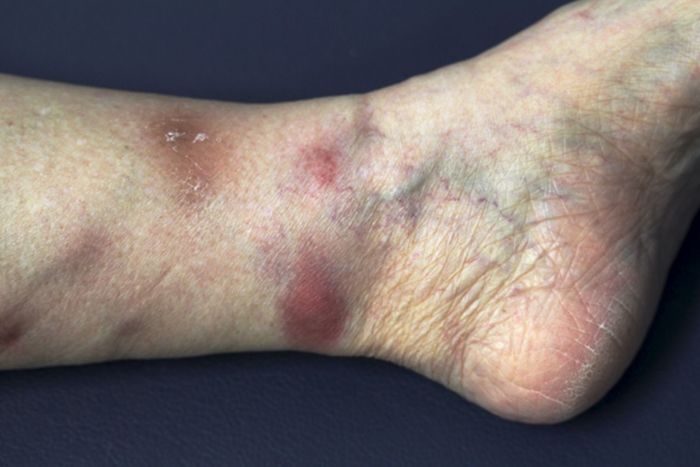 Panniculitis causes symptoms treatments and more