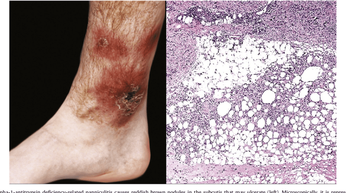 Panniculitis causes symptoms treatments and more