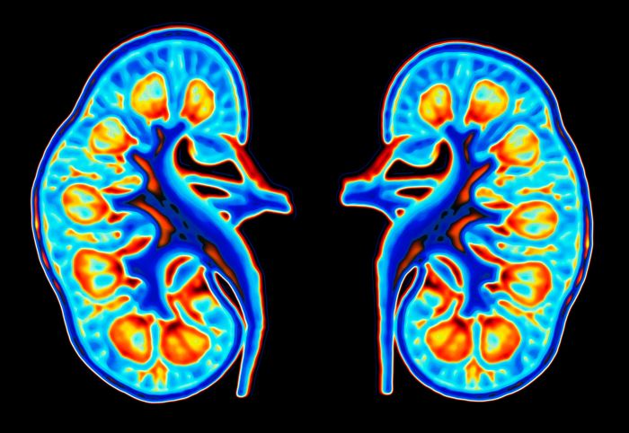 Renal cell carcinoma symptoms causes diagnosis and treatment