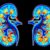 Renal Cell Carcinoma Symptoms, Causes, Diagnosis, and Treatment