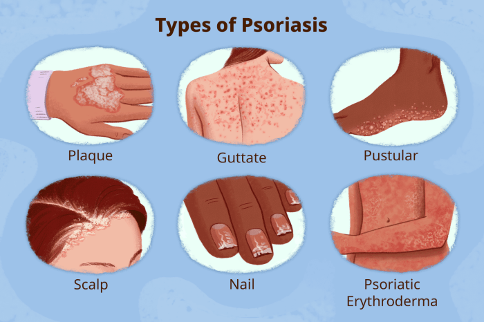 Pustular skin lesions in DIRA. Reprinted with permission from Henderson ... Pustular rash types treatment