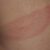 Rash That Moves A Deep Dive