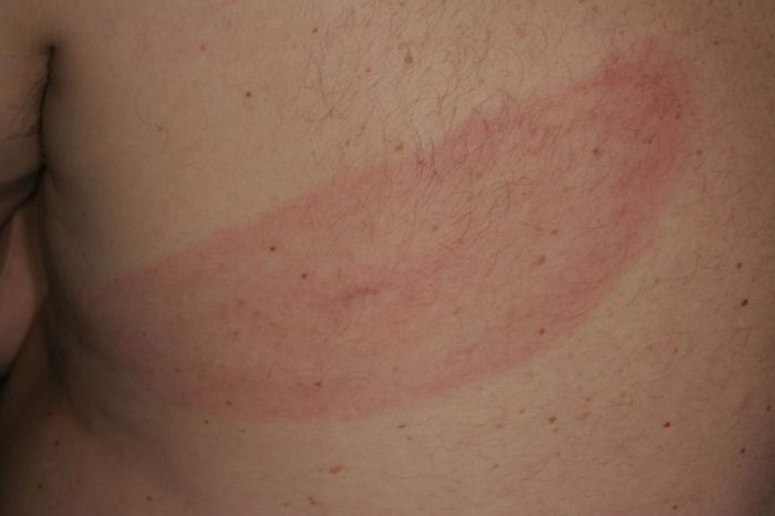 Rash That Moves A Deep Dive