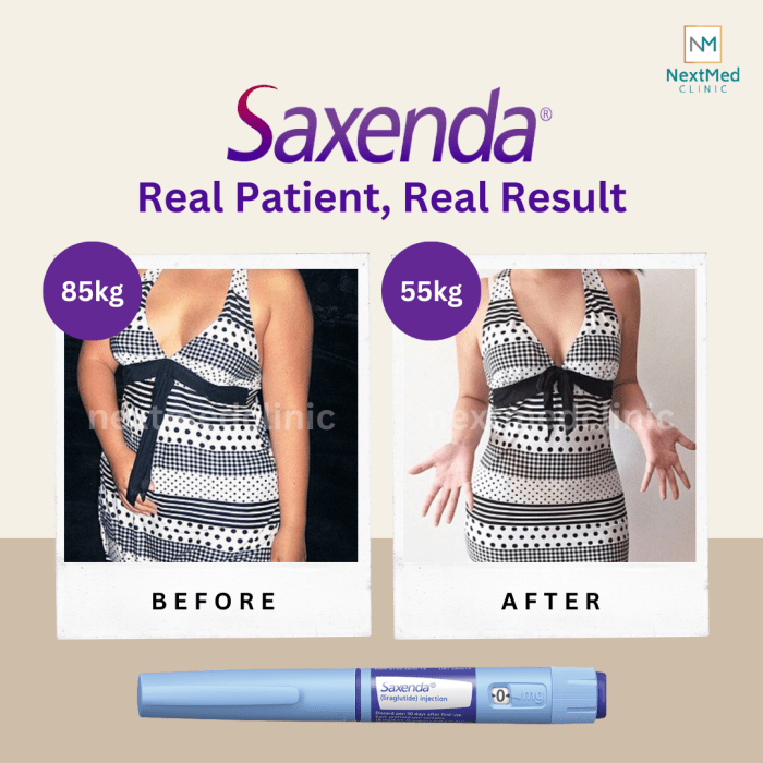 The differences between saxenda and wegovy