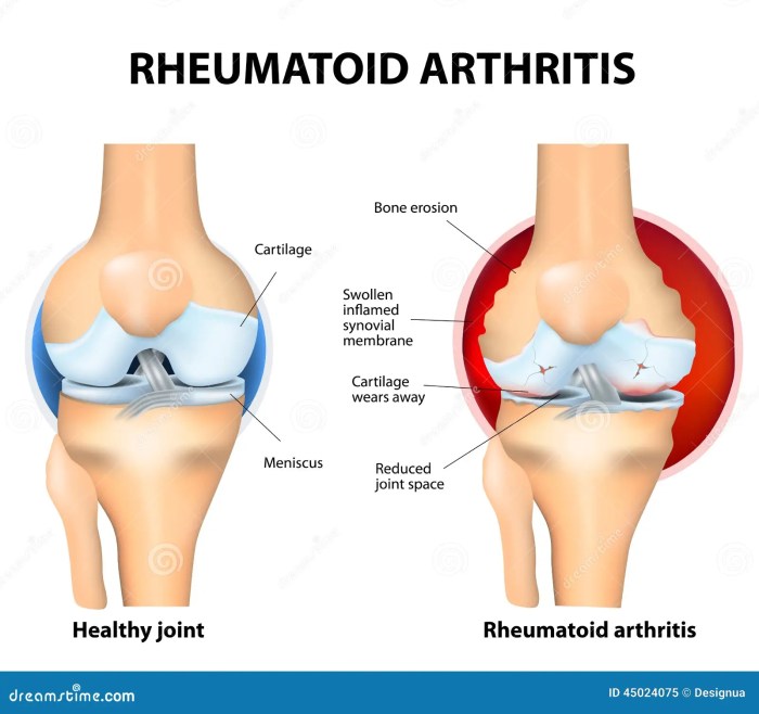 Rheumatoid arthritis flare up