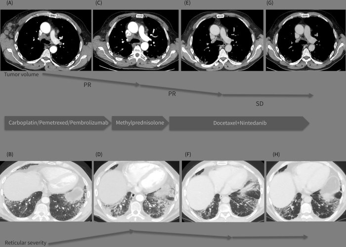 Frontiers | Successful treatment with docetaxel plus nintedanib in a ... Paroxysmal nocturnal dyspnea pnd