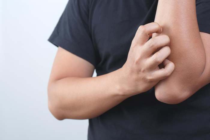 Extreme itch in fibromyalgia chronic fatigue syndrome