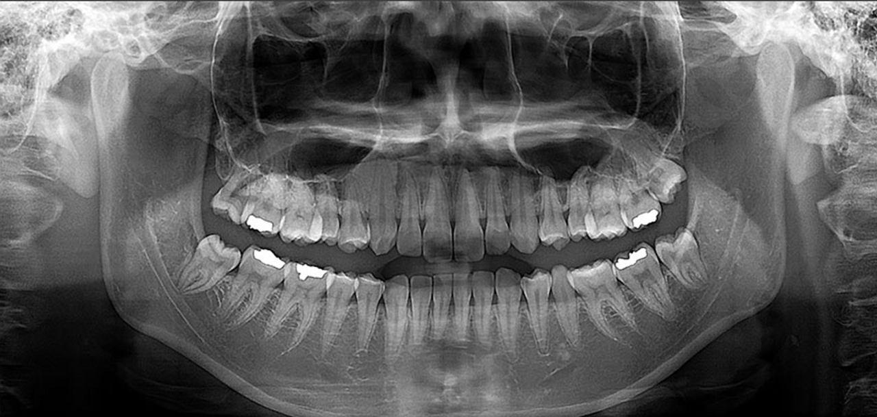 Panorex definition of panorex