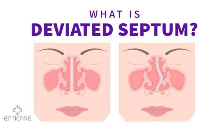 Deviated Septum: 10 Deviated Septum Symptoms What causes a deviated septum